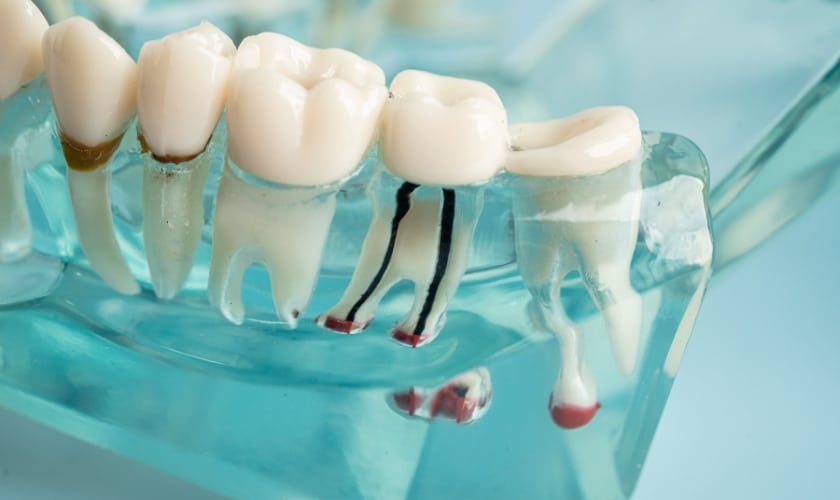 is root canal necessary for damaged teeth