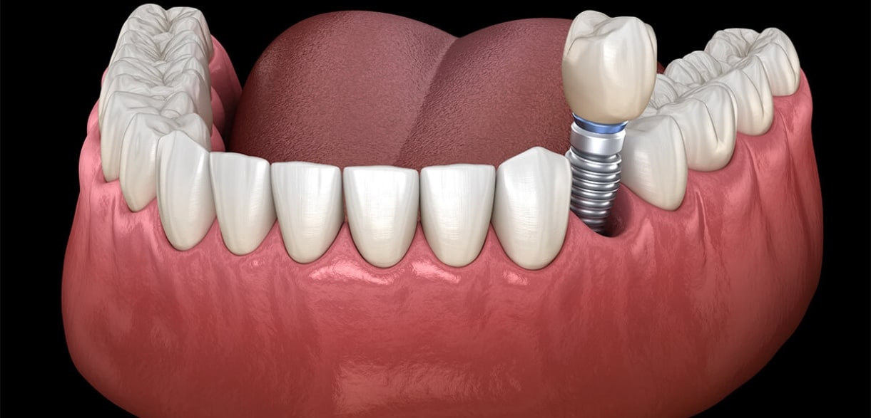 The Lifespan of Dental Implants How Long Do They Really Last