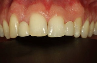after treatment-dental bonding