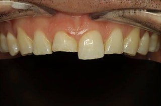 before treatment-chipped tooth
