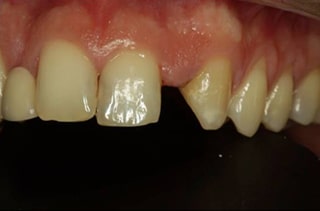 before treatment-gapped teeth