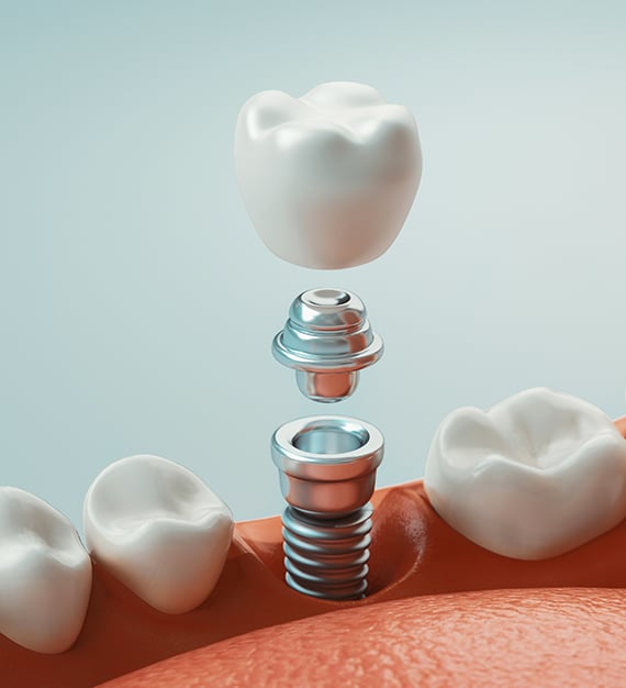 dental implants reston va expression dental care