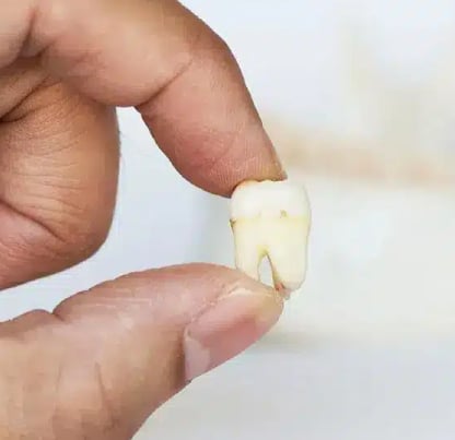 wisdom teeth extraction in reston va