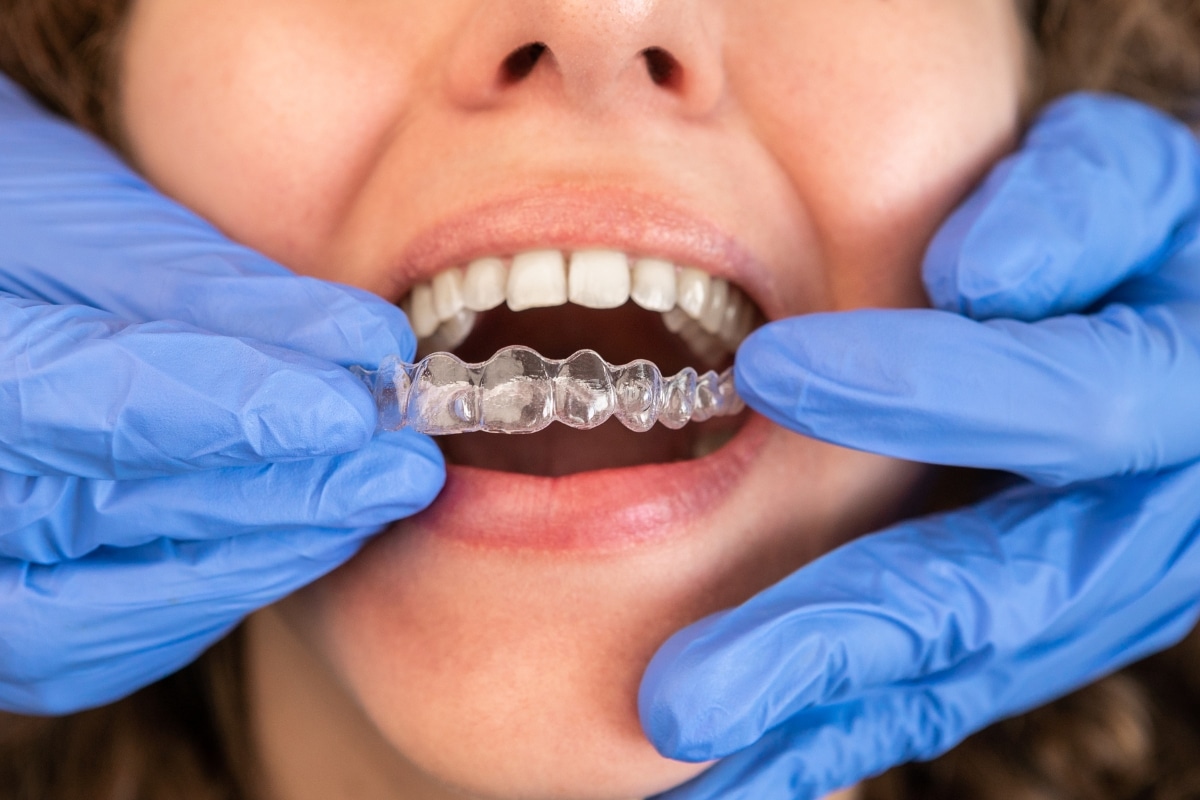 Invisalign-in-Reston